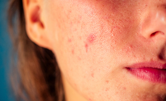 Different Stages of Acne - Stage 2
