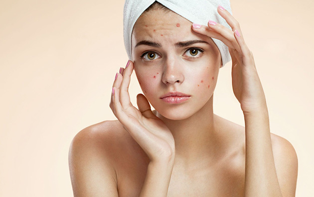 AcneStar Provides Glowing Skin