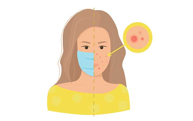 Maskne - causes and treatments- acnestar