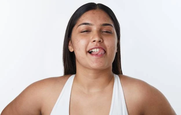 Ice vs. Heat: Which One Works Best for Pimples?