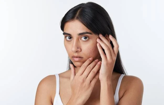 Managing Heat Acne: Tips to Prevent Summer Breakouts