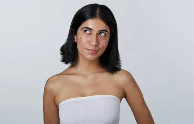 Top Foods That May Trigger Acne (And What to Eat Instead)