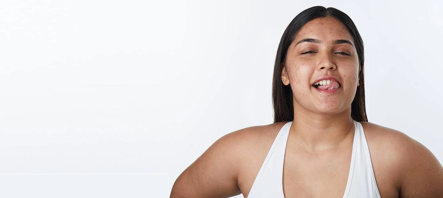 Ice vs. Heat: Which One Works Best for Pimples?