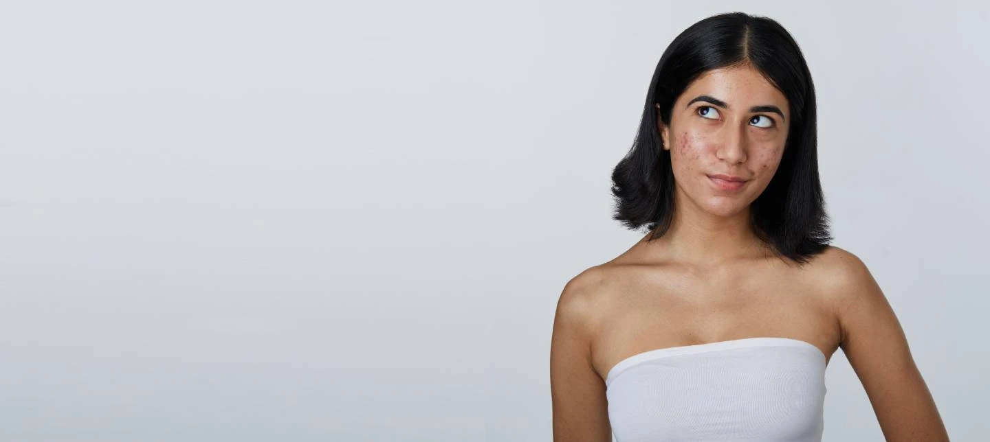 Top Foods That May Trigger Acne (And What to Eat Instead)