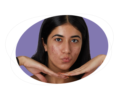 Can this gel be used on other skin infections besides acne?