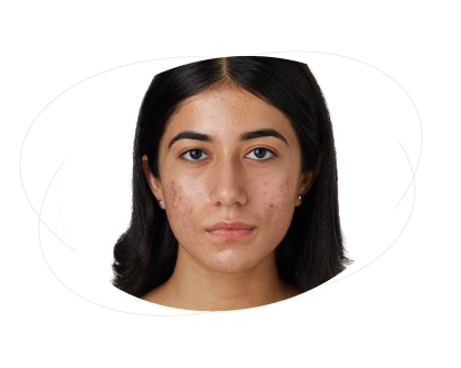 What should I do if I experience irritation or side effects?